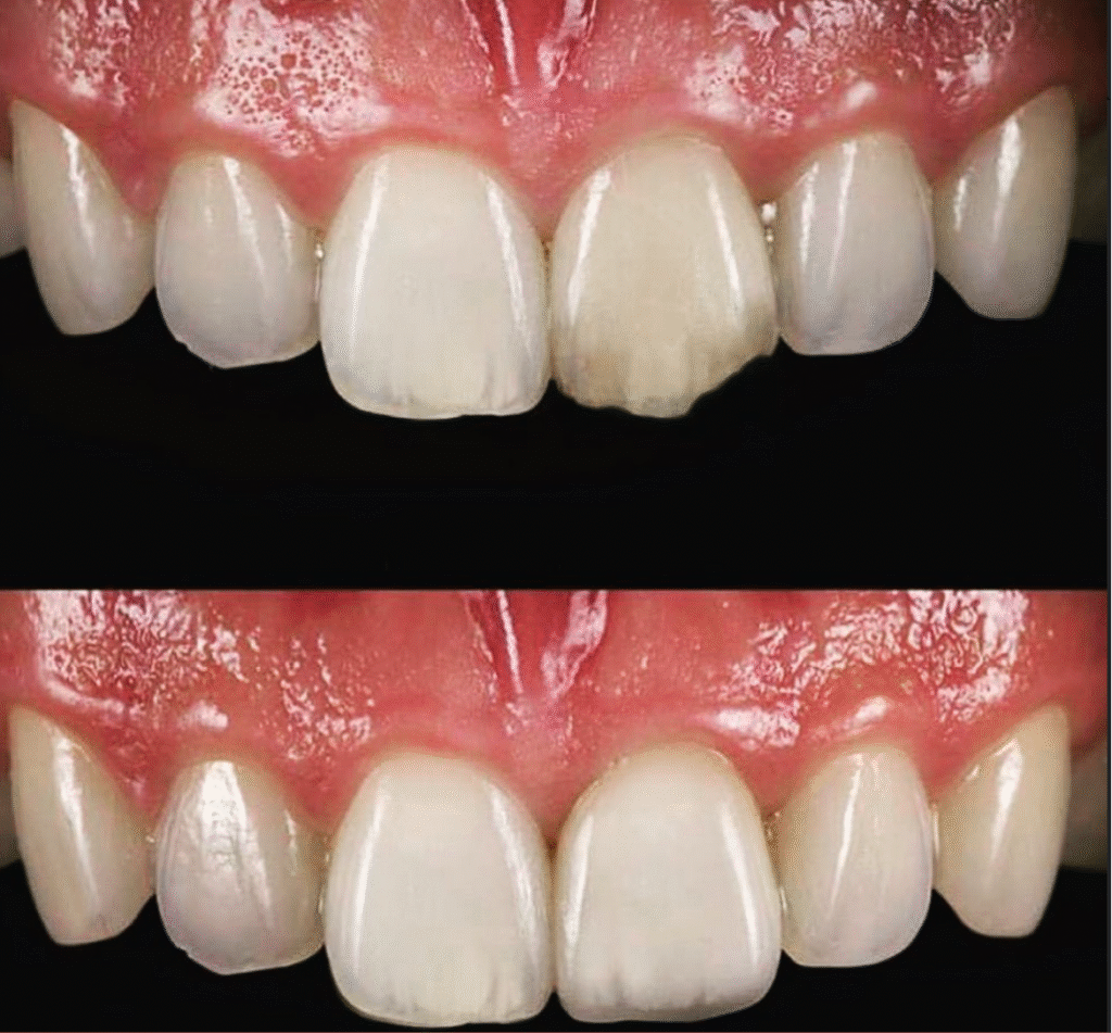 Close view of upper front teeth and gums before cosmetic dental treatment at Greenwich Dental Studio.
