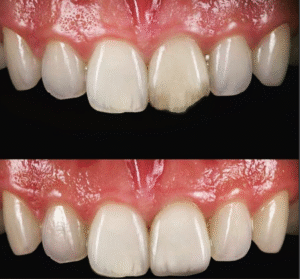 Dental bonding case study.