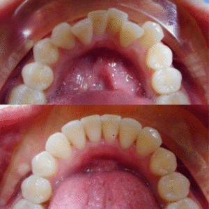 Invisalign case study with before and after results.